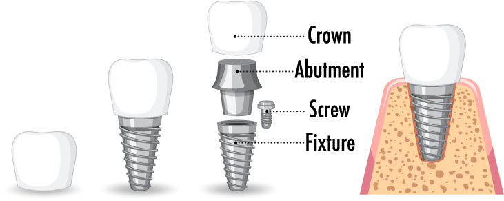 การรีดเกลียวความแม่นยำสูงสำหรับรากฟันเทียม YAMAWA (JSR Group)